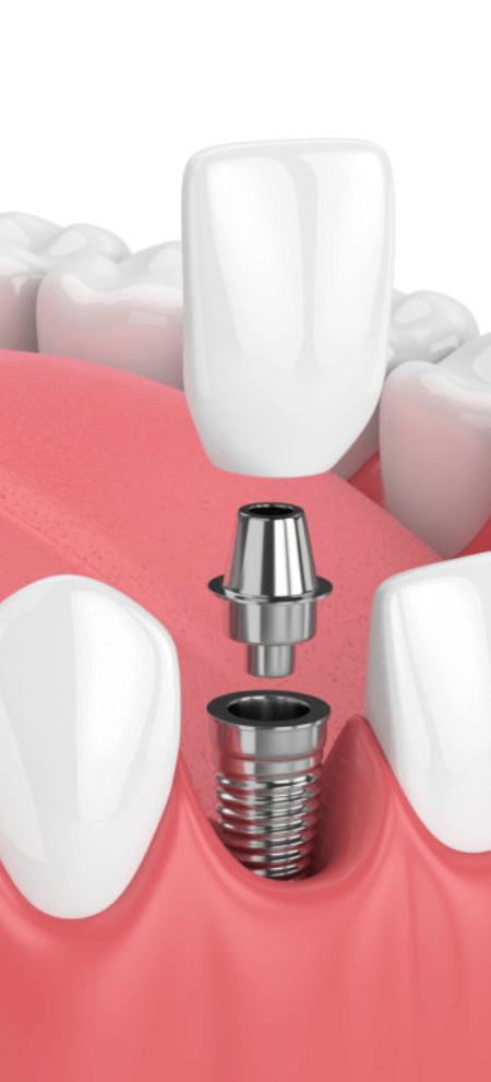 Dental Implants | SmileCode Dental | NW Calgary | General Dentist