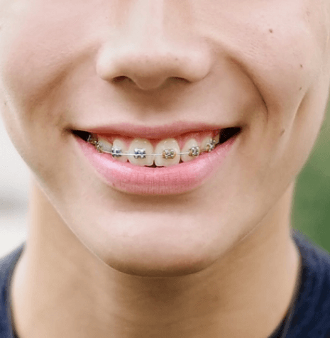 Orthodontic Dentistry | SmileCode Dental | NW Calgary | General Dentist