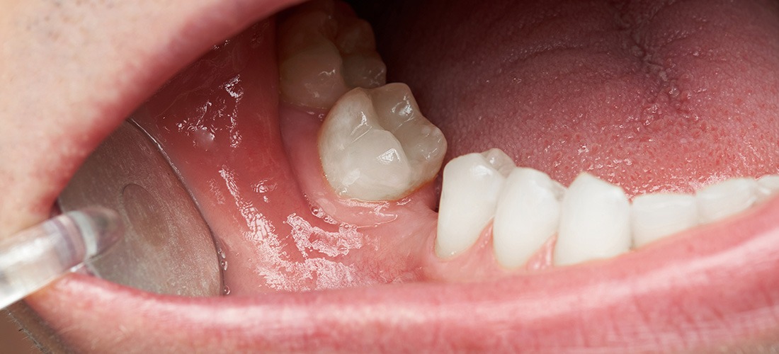 Bone Graft | Socket Preservation | SmileCode Dental | NW Calgary | General Dentist
