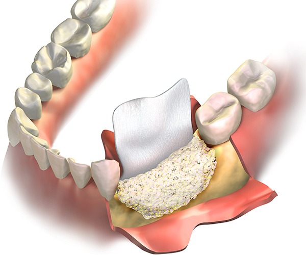 Bone Graft | Socket Preservation | SmileCode Dental | NW Calgary | General Dentist