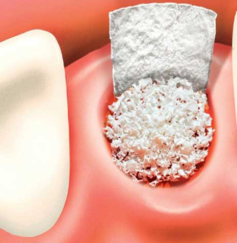 Bone Grafting | SmileCode Dental | NW Calgary | General Dentist