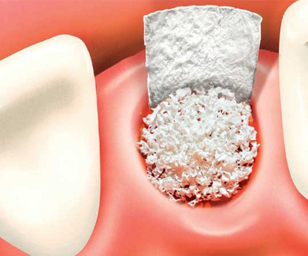 Bone Graft | Socket Preservation | SmileCode Dental | NW Calgary | General Dentist