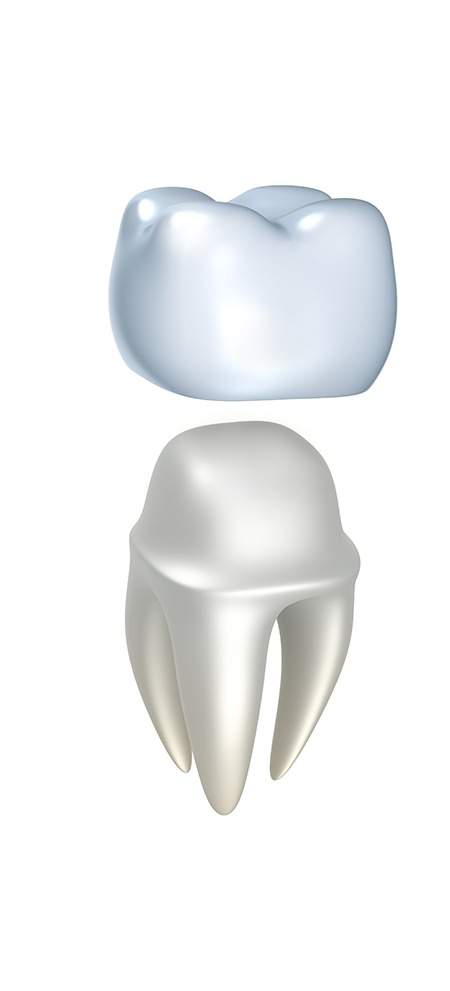 Dental Crown | SmileCode Dental | NW Calgary | General Dentist