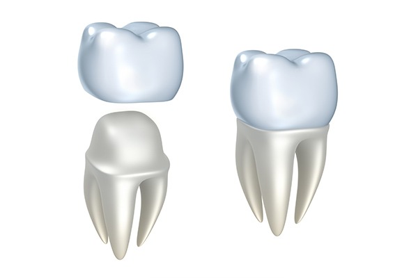 Dental Crown | SmileCode Dental | NW Calgary | General Dentist