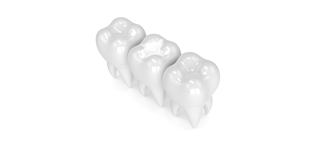 Dental Fillings | SmileCode Dental | NW Calgary | General Dentist
