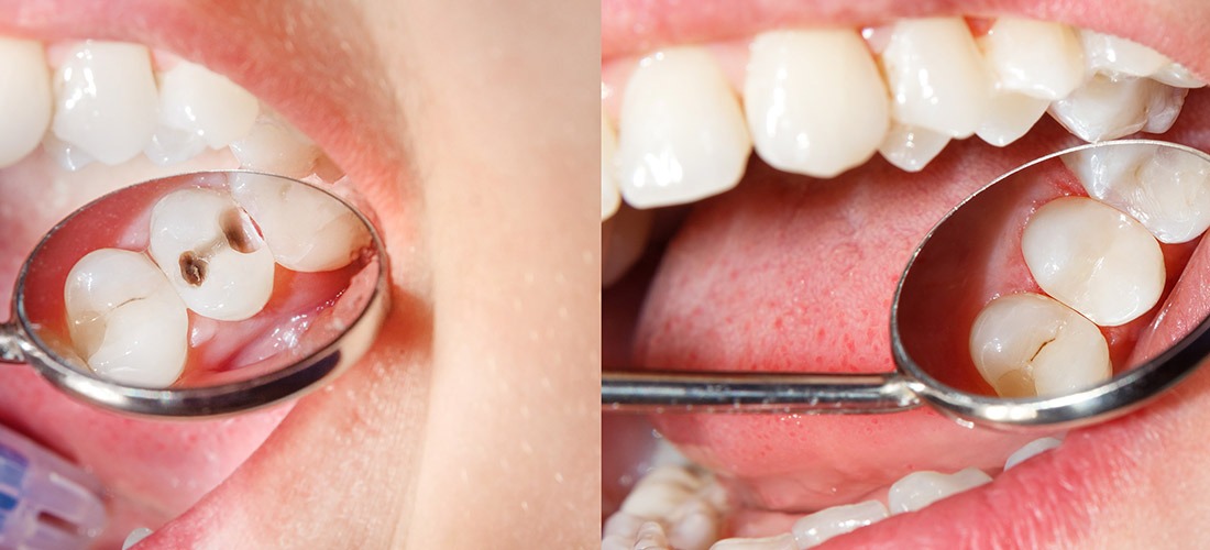 Endodontics | SmileCode Dental | NW Calgary | General Dentist