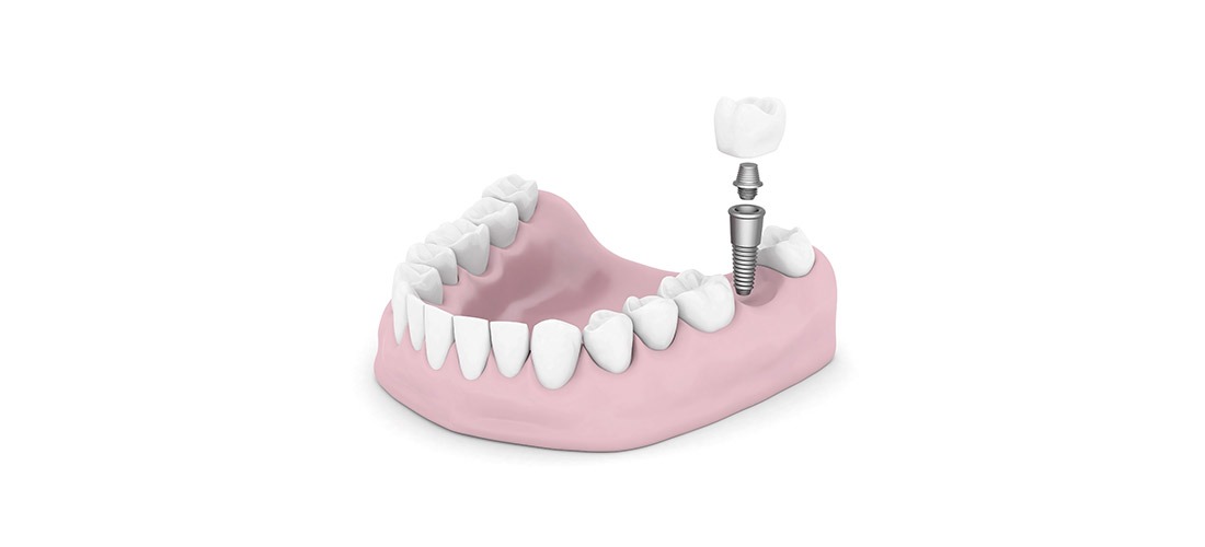 Dental Implant | SmileCode Dental | NW Calgary | General Dentist