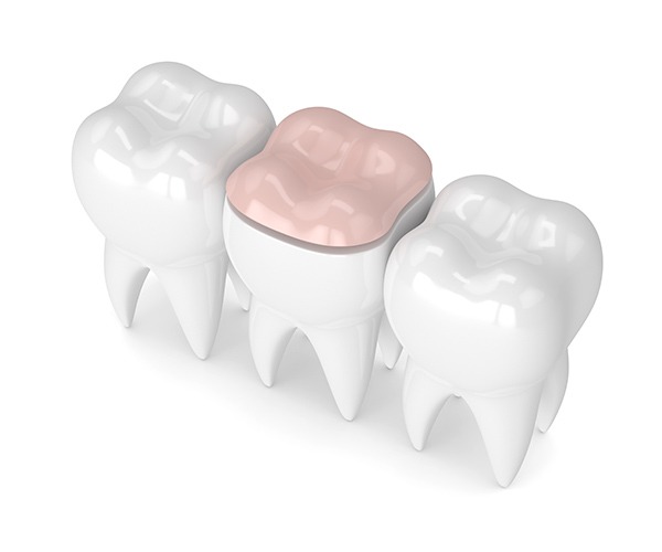 Inlay and Onlay | SmileCode Dental | NW Calgary | General Dentist