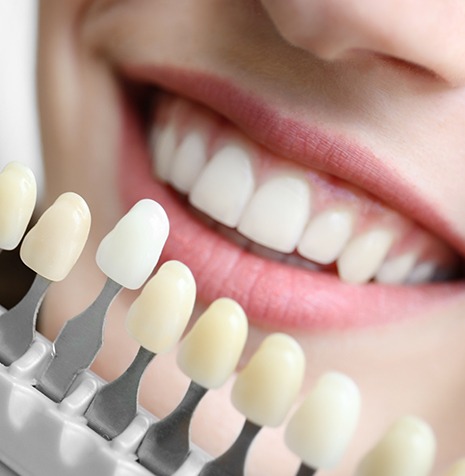 Dental Veneers | SmileCode Dental | NW Calgary | General Dentist