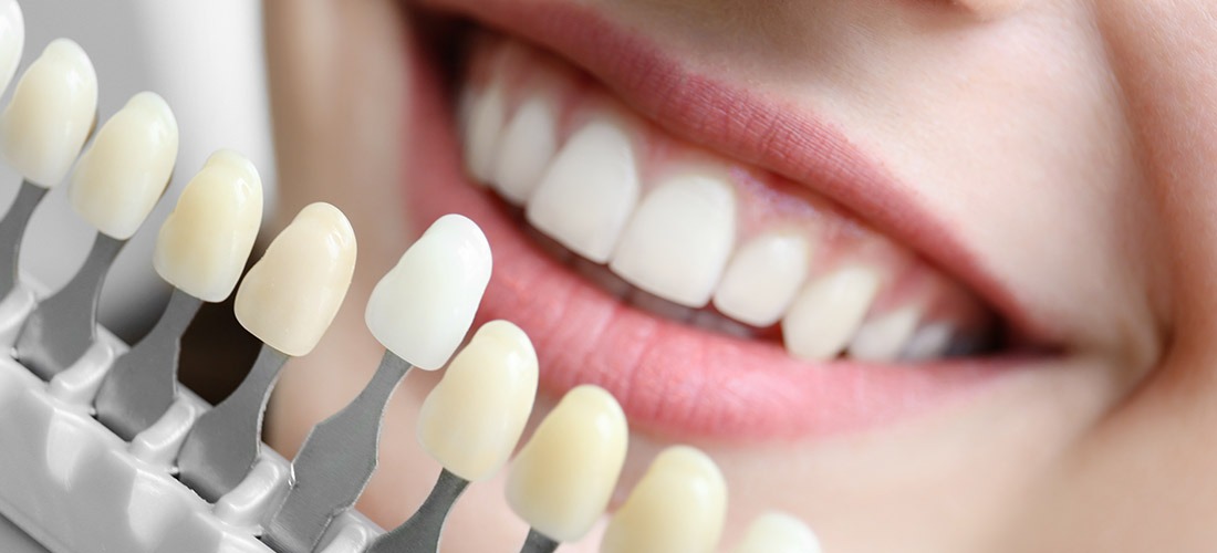 Dental Veneers | SmileCode Dental | NW Calgary | General Dentist