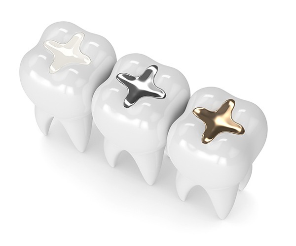 Dental Fillings | SmileCode Dental | NW Calgary | General Dentist