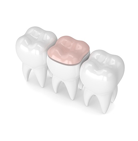 Inlays and Onlays | SmileCode Dental | NW Calgary | General Dentist