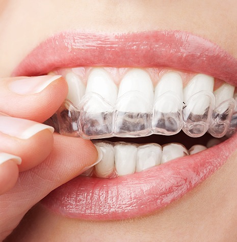 Invisalign Clear Aligners | SmileCode Dental | NW Calgary | General Dentist