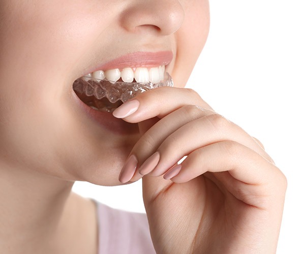 TMD/TMJ | Mouth Guard | SmileCode Dental | NW Calgary | General Dentist