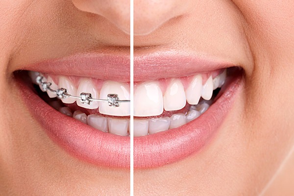 Orthodontics | Braces | SmileCode Dental | NW Calgary | General Dentist