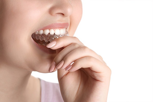 Orthodontics | SmileCode Dental | NW Calgary | General Dentist