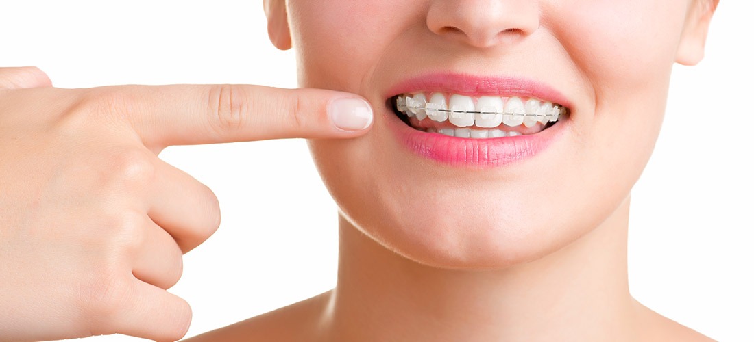 Orthodontics | SmileCode Dental | NW Calgary | General Dentist