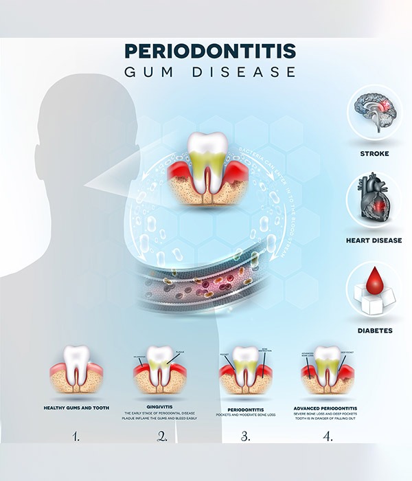 Periodontitis | SmileCode Dental | NW Calgary | General Dentist