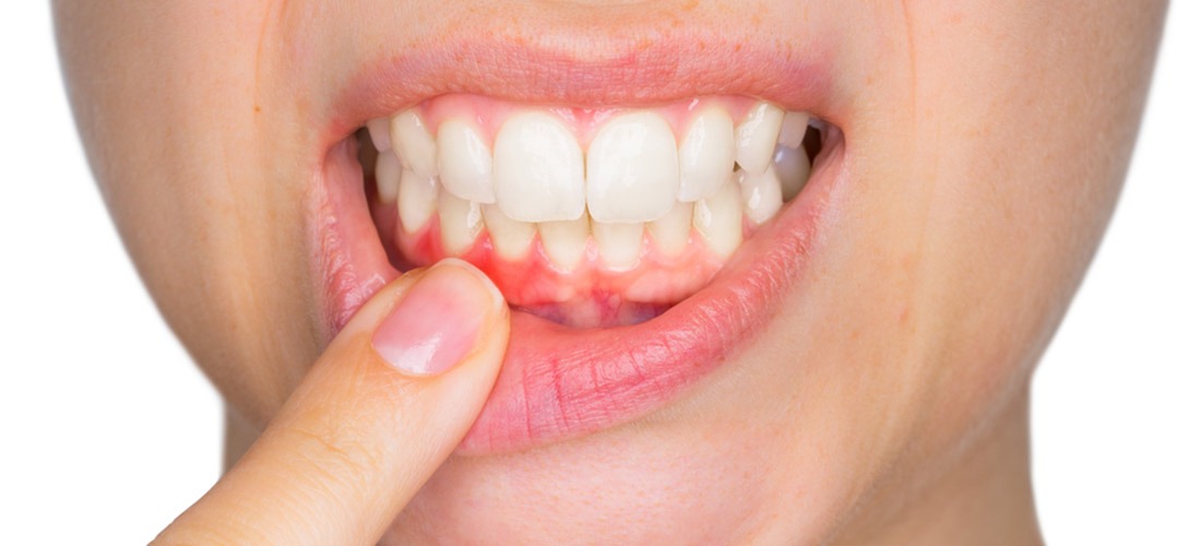 Periodontics | SmileCode Dental | NW Calgary | General Dentist
