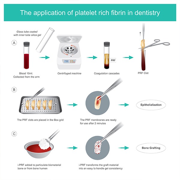 Platelet Rich Fibrin Process | SmileCode Dental | NW Calgary | General Dentist