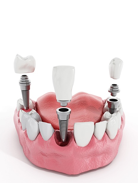 Restorative Dentistry | SmileCode Dental | NW Calgary | General Dentist