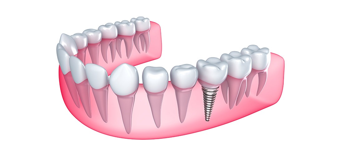 Restorative Dentistry | SmileCode Dental | NW Calgary | General Dentist