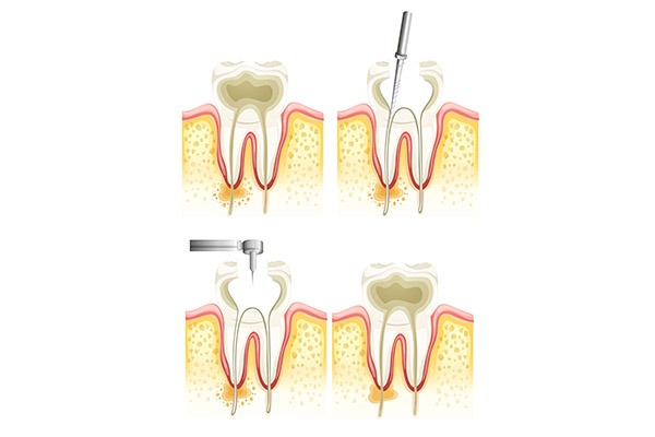 Root Canal Process | SmileCode Dental | NW Calgary | General Dentist