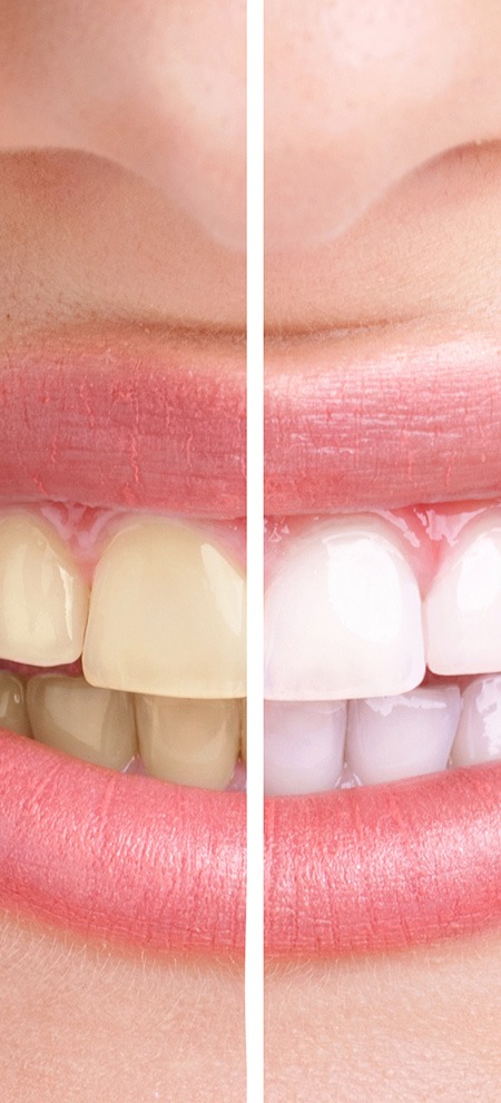 Teeth Whitening | SmileCode Dental | NW Calgary | General Dentist