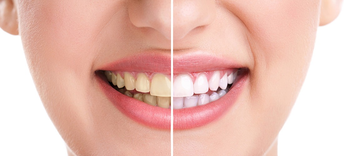 Teeth Whitening | SmileCode Dental | NW Calgary | General Dentist
