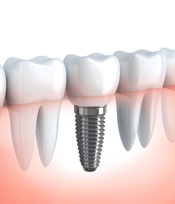 Dental Implant | SmileCode Dental | NW Calgary | General Dentist