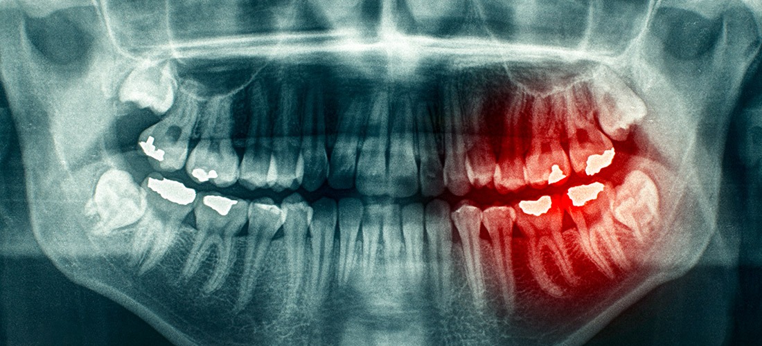 Wisdom Teeth Removal | SmileCode Dental | NW Calgary | General Dentist