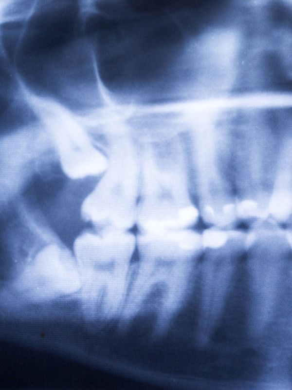 Wisdom Teeth Removal | SmileCode Dental | NW Calgary | General Dentist