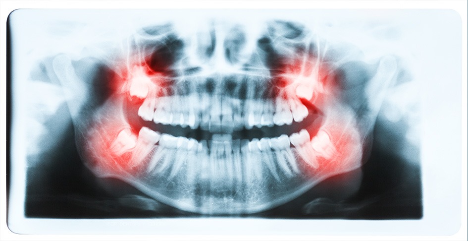 Wisdom Teeth Removal | SmileCode Dental | NW Calgary | General Dentist